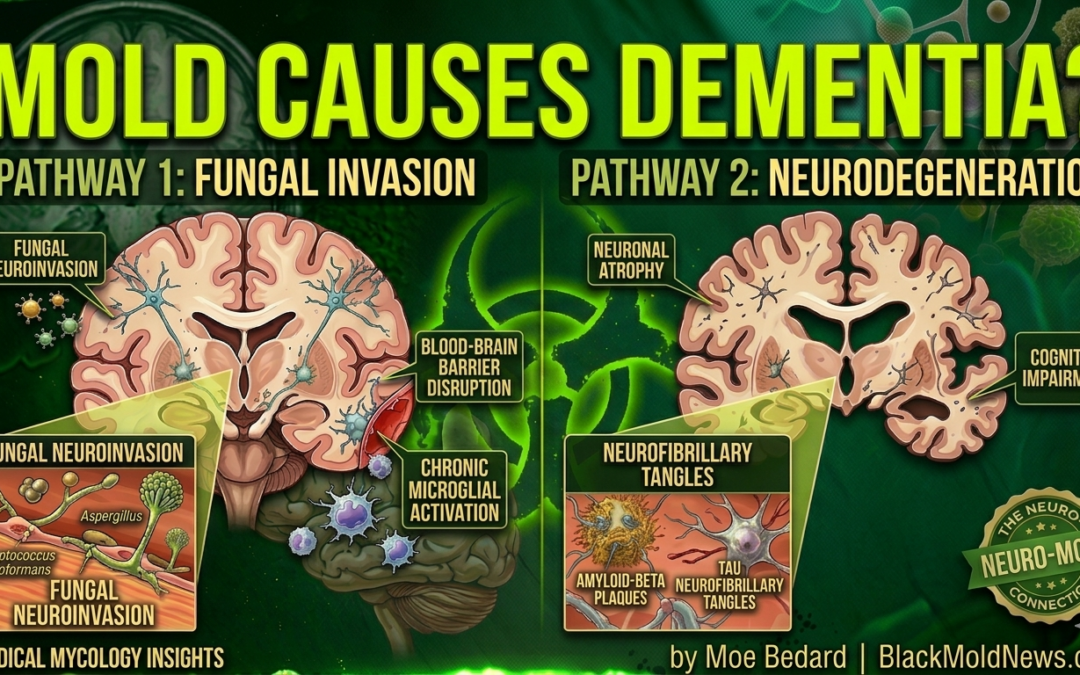 How Fungal Infections & Mold Illness Cause Dementia and Alzheimer’s Disease